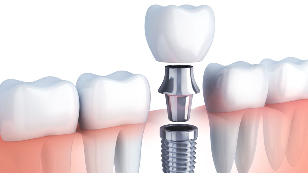 Dental İmplant Tedavisi